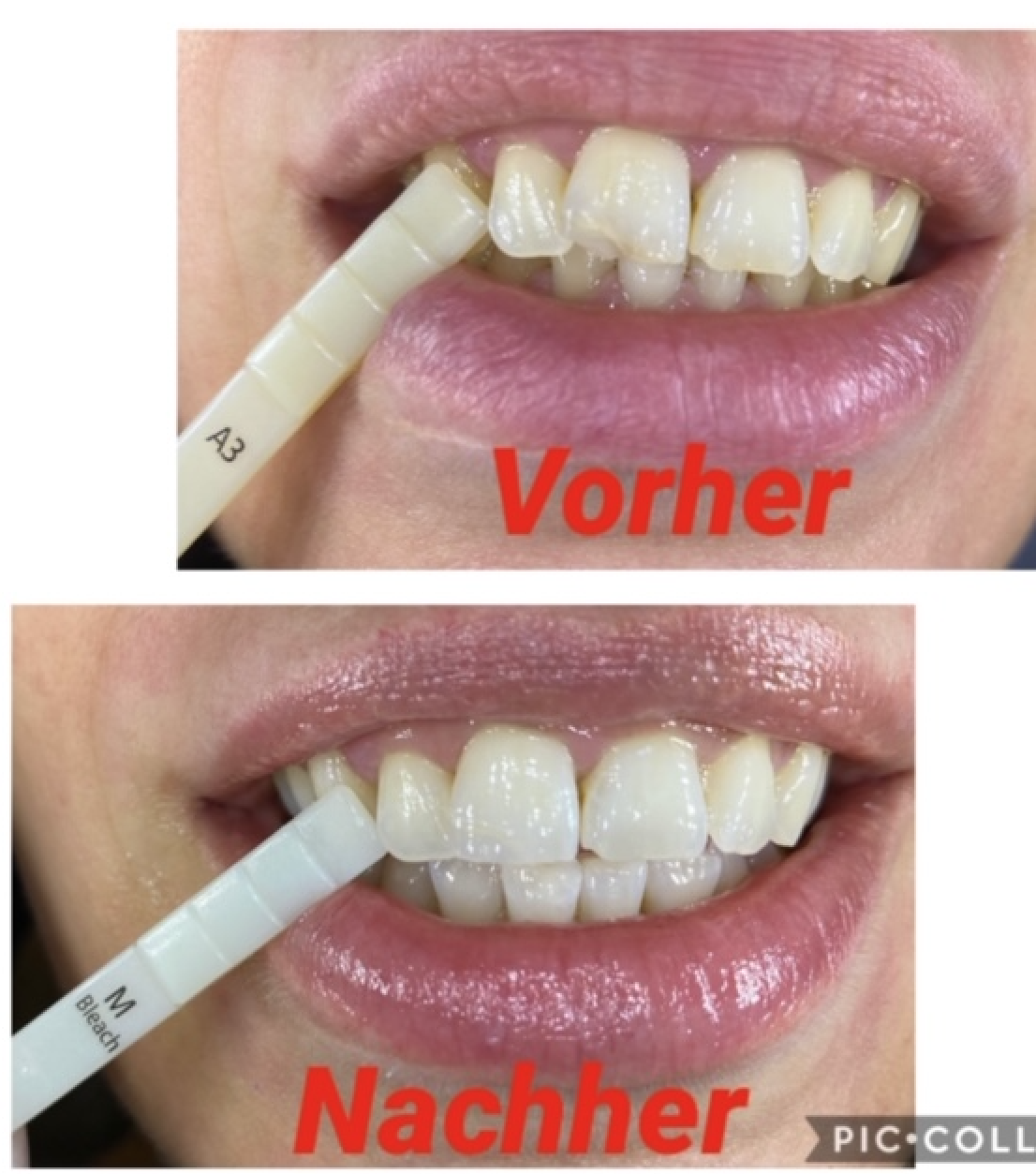 Bleaching (Zahnaufhellung) Praxis Nielsen
